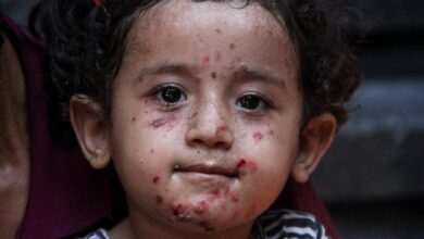 Tragedy of Gaza is turning into a never healing wound