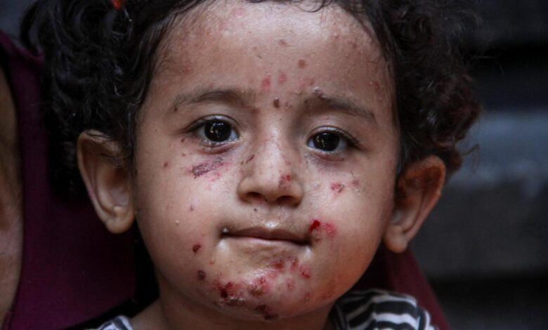 Tragedy of Gaza is turning into a never healing wound